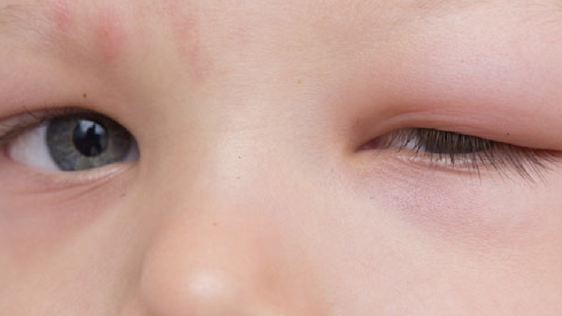 Eye allergies, eye allergies in children, causes of eye allergies